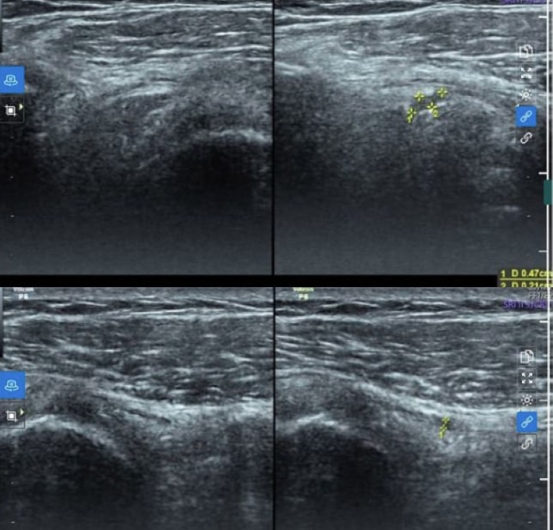 Hình ảnh tổn thương được phát hiện trên siêu âm khớp vai  