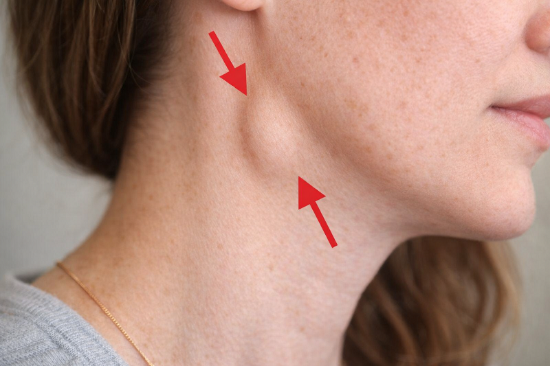 Hạch cổ có thể sưng to khi cơ thể bị viêm nhiễm hoặc mắc các bệnh lý liên quan đến tuyến giáp.