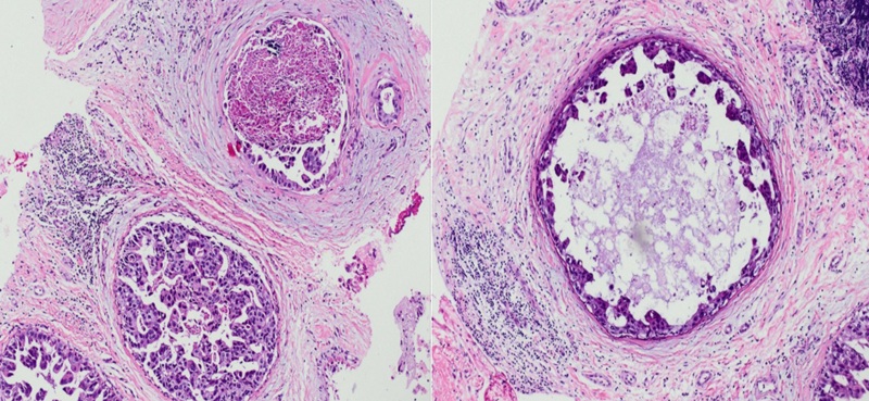 Hình ảnh giải phẫu bệnh cho thấy phù hợp với ung thư biểu mô ống tại chỗ 
