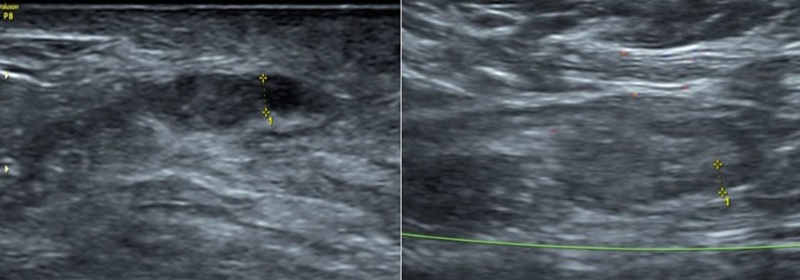 Hình ảnh siêu âm tuyến vú phát hiện đám giảm âm kèm giãn ống tuyến vú phải 