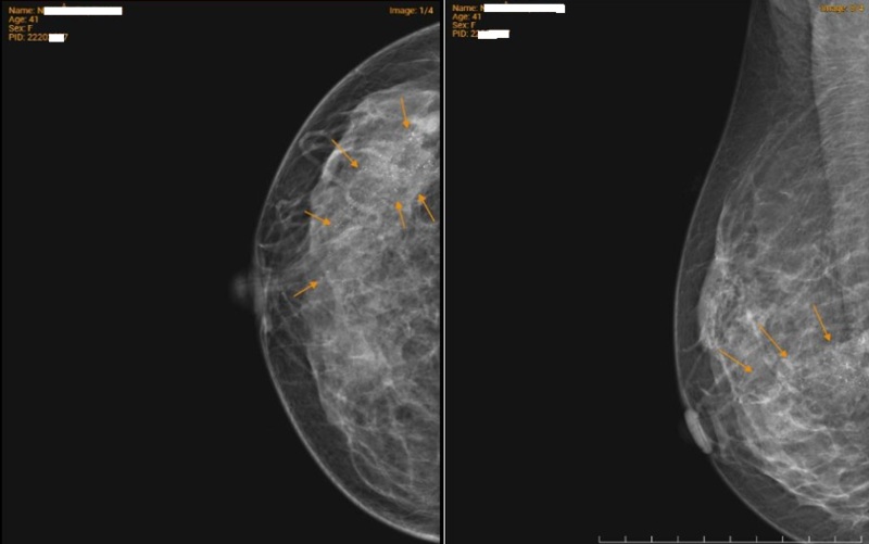 Chụp X-quang tuyến vú ghi nhận nốt vôi hóa tập trung thành đám tại vú phải 