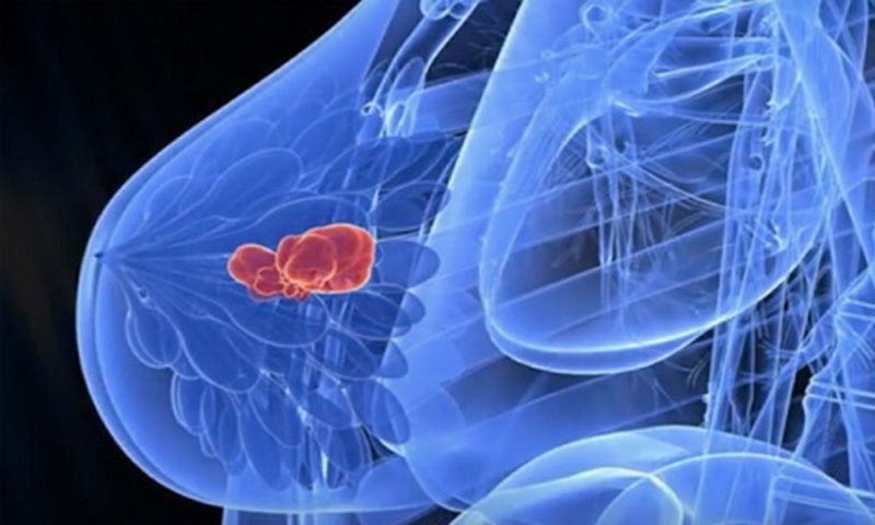 Ung thư vú là loại phổ biến nhất trong các bệnh ung thư tại Việt Nam. Ảnh minh họa 