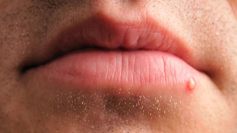 Nam thanh niên đến Phòng khám Đa khoa MEDLATEC Thanh Xuân khám do xuất hiện vài mụn nước nhỏ ở viền môi dưới. Ảnh minh họa, nguồn Internet