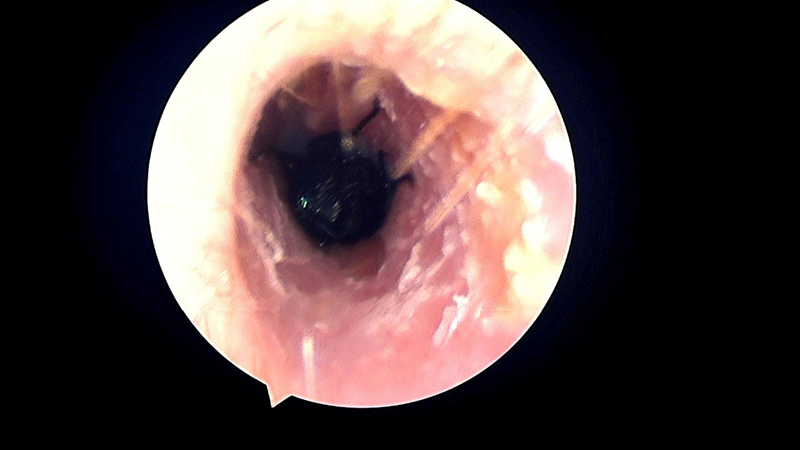 Hình ảnh nội soi cho thấy con ruồi trâu trong ống tai của người bệnh