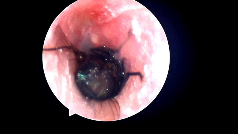 Hình ảnh nội soi cho thấy con ruồi trâu trong ống tai của người bệnh