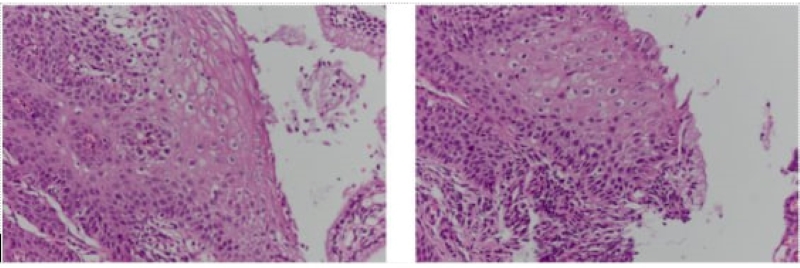 Tổn thương được phát hiện trên kết quả giải phẫu bệnh sinh thiết cổ tử cung   