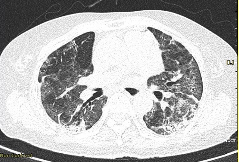 Nhu cầu khám phổi sau Covid-19 là do nguyên nhân gì?

