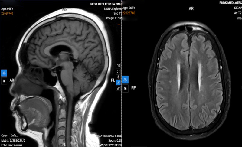 Hình ảnh chụp MRI sọ não của bệnh nhân thấy có dấu hiệu thoái hóa myelin chất trắng