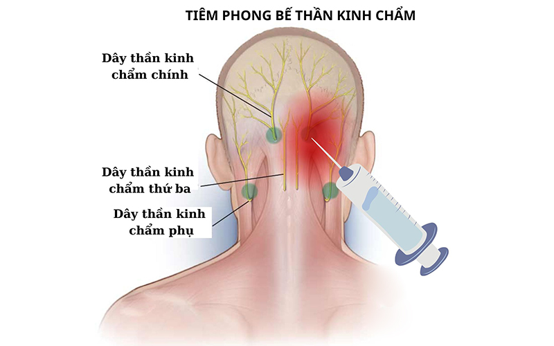 Tiêm phong bế thần kinh chẩm có tác dụng nhanh chóng, giảm đau rõ rệt chỉ sau khoảng 15 phút. Ảnh minh họa internet