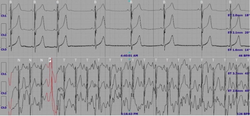Bất thường được phát hiện trên kết quả Holter điện tim 24 giờ  
