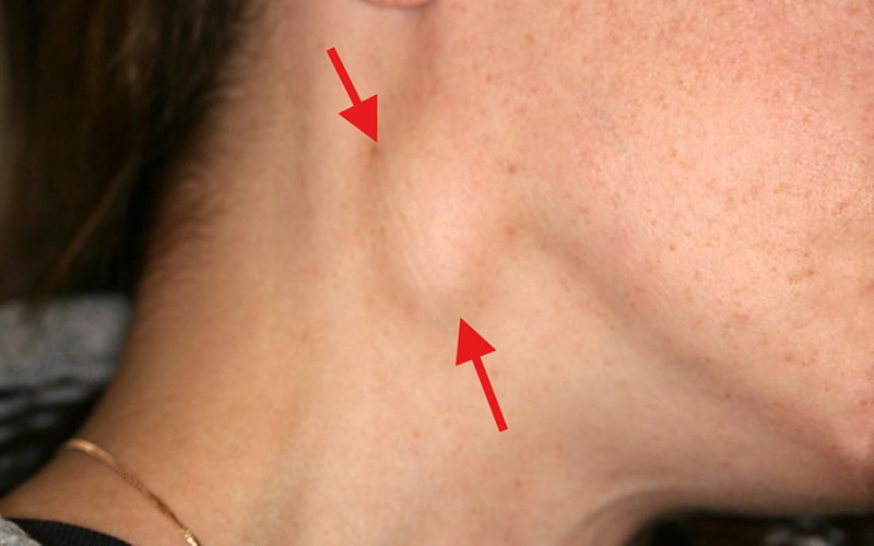 Hạch bạch huyết là một phần của hệ miễn dịch, giúp cơ thể chống lại vi khuẩn và virus gây bệnh.