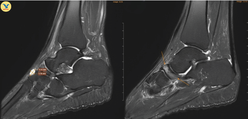 Hình ảnh chụp MRI cho thấy những dấu hiệu đặc trưng của Hội chứng Mueller-Weiss ở chân phải 