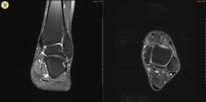 MRI chân trái ghi nhận hình ảnh thoái hóa khớp và phù nề 