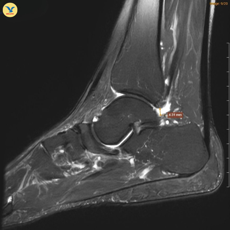 MRI chân trái ghi nhận hình ảnh thoái hóa khớp và phù nề 