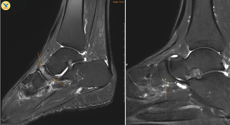 Hình ảnh MRI cho thấy xương ghe ở bệnh nhân mắc Hội chứng Müller–Weiss (bên trái) có vùng sáng hơn bất thường, trong khi xương ghe ở bàn chân bình thường (bên phải) có hình ảnh đồng nhất hơn