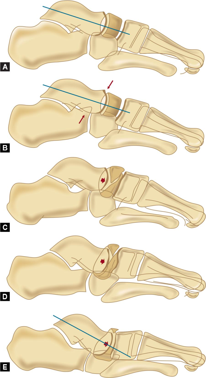 Sơ đồ mô tả các giai đoạn của hội chứng Mueller-Weiss theo phân loại Maceira dựa trên hình ảnh X-quang bàn chân tư thế nghiêng có chịu lực. Ảnh minh họa 