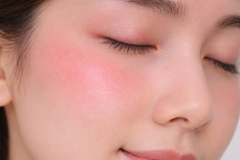 Một số làn da nhạy cảm có thể xuất hiện châm chích nhẹ khi tiếp xúc với acid lactic trong sữa chua.