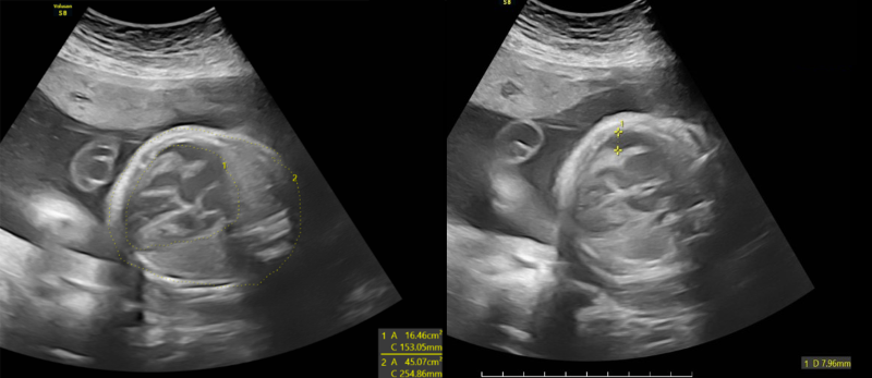 Các bất thường ở thai nhi được phát hiện trên hình ảnh siêu âm  