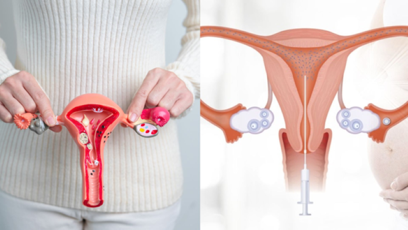 Tình trạng vòi trứng là một trong các yếu tố quyết định đến việc có làm IUI được không