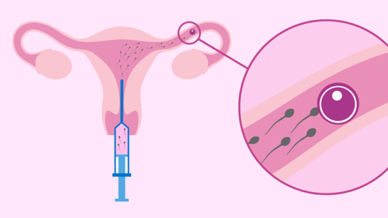 Vòi trứng thông hạn chế có làm IUI được không là băn khoăn của nhiều cặp đôi