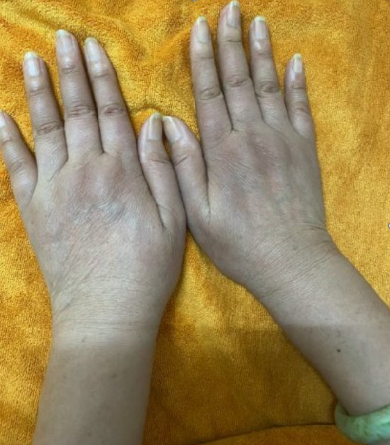 Bàn tay của bệnh nhân có biểu hiện của hội chứng Raynaud 