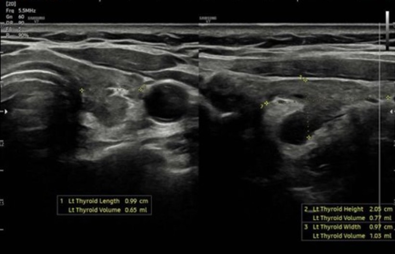 Siêu âm tuyến giáp gợi ý hình ảnh theo dõi bệnh lý chủ mô tuyến giáp lan tỏa 