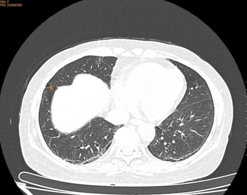 CT phổi cho thấy hình ảnh giãn phế nang thùy giữa phổi phải, giãn phế quản thùy dưới hai phổi, dải xơ, dày tổ chức kẽ hai phổi 