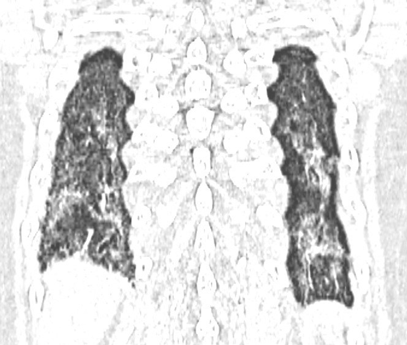 Hình ảnh hai lá phổi xơ hóa 