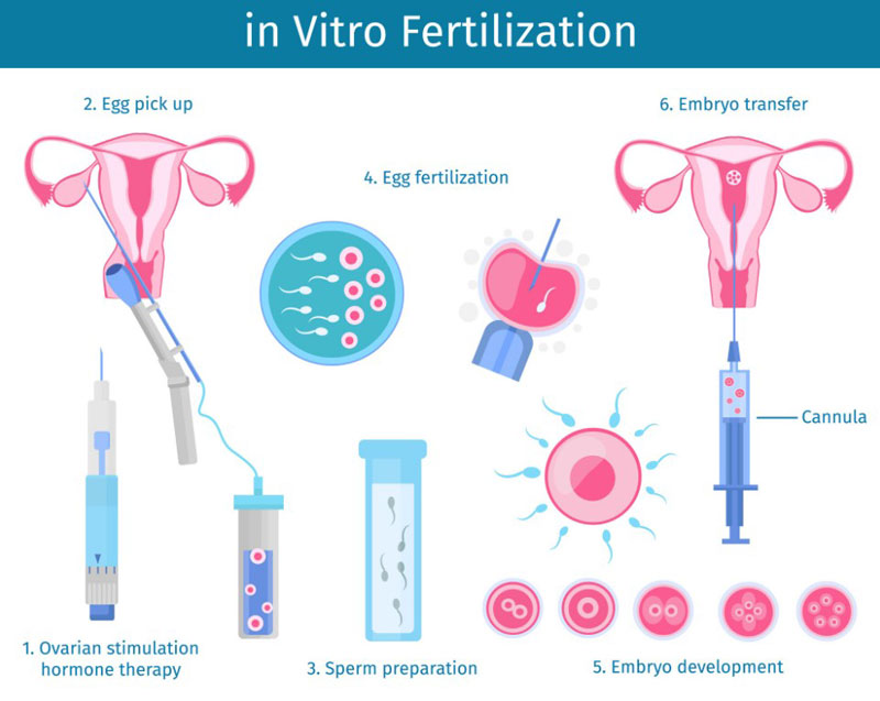 Thụ tinh trong ống nghiệm IVF – phương pháp tìm con dành cho những cặp cha mẹ hiếm muộn