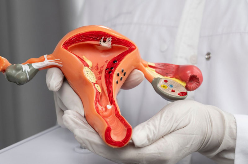 U xơ tử cung thường là khối u lành tính ở lớp cơ của tử cung