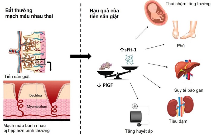 Một số hậu quả của tiền sản giật gây ra cho thai phụ 