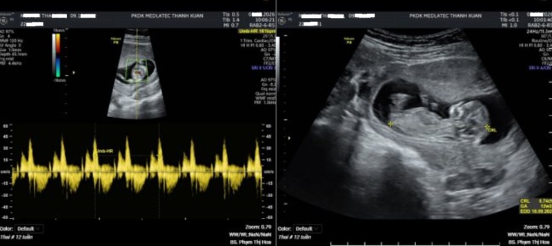 Kết quả siêu âm thai của thai phụ 