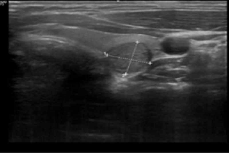 Siêu âm tuyến giáp ghi phát hiện có nhân giảm âm - dấu hiệu nghi ngờ ác tính  