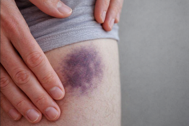 Khi gặp tình trạng bầm tím kéo dài, người bệnh nên đi khám