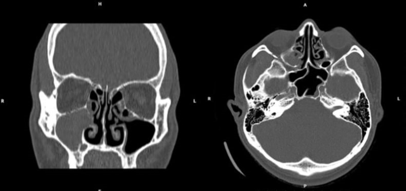 Hình ảnh chụp cắt lớp vi tính xoang phát hiện tình trạng viêm đa xoang mức độ III  