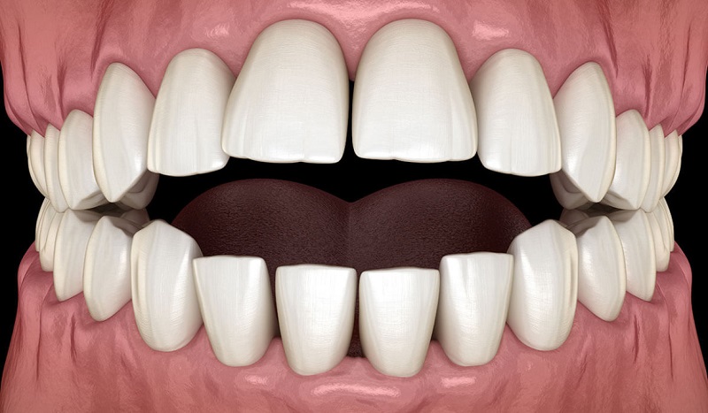 Làm sao để nhận biết mình đang gặp phải tình trạng 2 hàm răng không chạm nhau?
