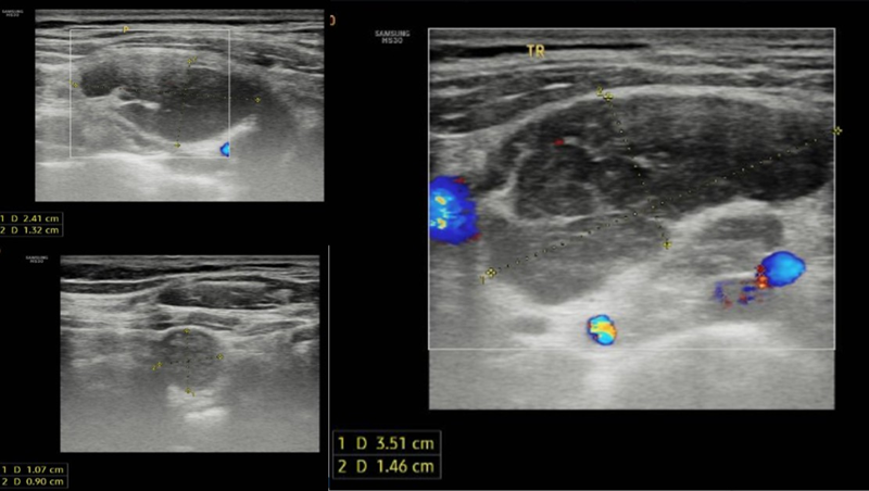 Siêu âm tuyến giáp ghi nhận hạch vùng cổ và hố thượng đòn hai bên 