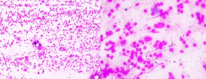 Trên phiến đồ thấy tăng sinh mạnh các tế bào lympho kích thước trung bình đến lớn, các tế bào có nhân kiềm tính, chất nhiễm sắc thô, màng nhân méo mó không đều 