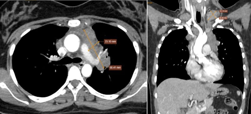 Hình ảnh tổn thương trung thất trên, lan vào rốn phổi trái, ôm quanh và làm hẹp lòng các nhánh động mạch-tĩnh mạch phổi và phế quản thùy trên, nhiều hạch bất thường trung thất và nền cổ hai bên, nốt nhỏ rải rác thùy dưới 2 phổi 