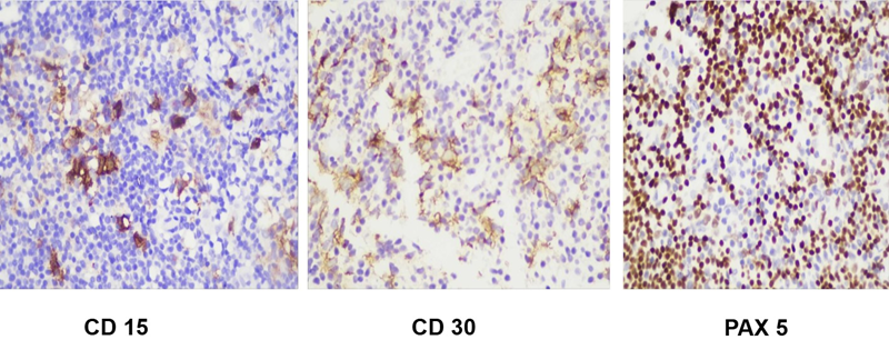 Kết quả hóa mô miễn dịch kết luận phù hợp u lympho Hodgkin kinh điển 