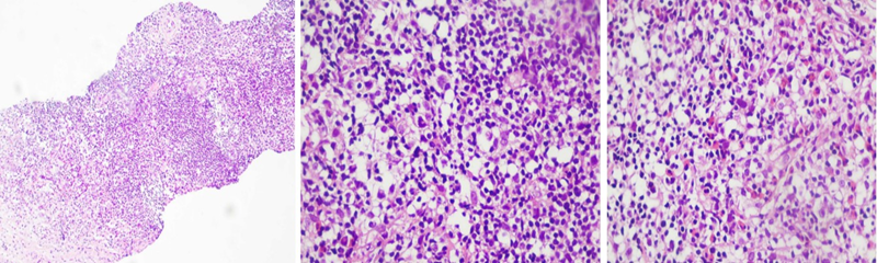 Kết quả mô bệnh học mẫu sinh thiết hạch thượng đòn trái cho thấy nhiều bạch cầu đa nhân, một số ổ viêm hạt, một số tế bào nhân lớn, kiềm tính, đứng rải rác 