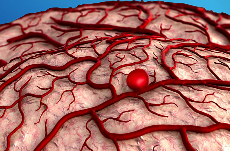 Phình mạch máu não có nguy hiểm không và có thể dẫn đến những biến chứng nào?

