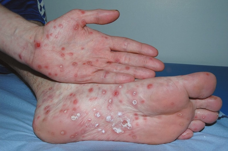 Các vết loét trên da là triệu chứng điển hình của bệnh giang mai. Ảnh minh họa 