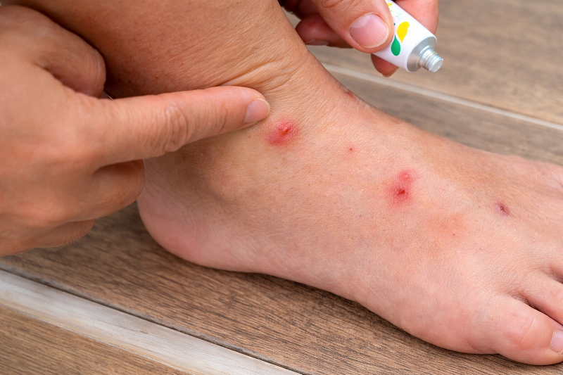 Các nốt bọ chó đốt xuất hiện thành cụm ở vùng cổ chân và cẳng chân