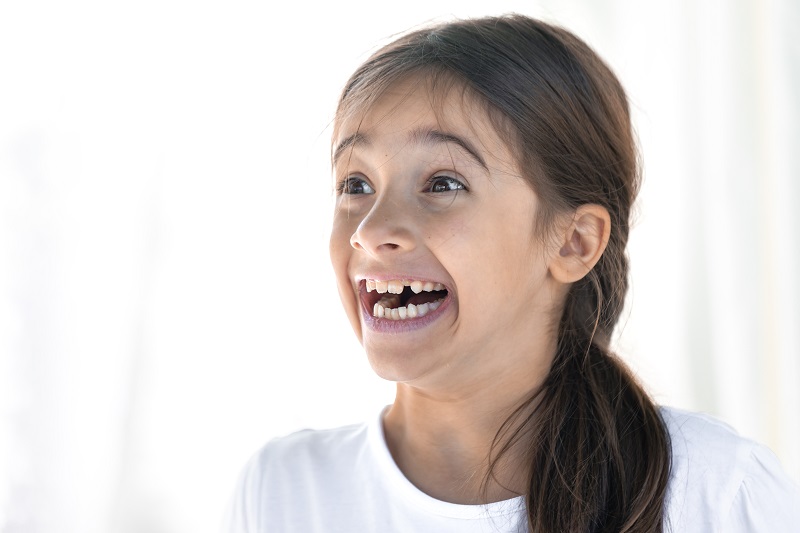 Răng mọc lệch nhiều có thể niềng mắc cài tự buộc để đảm bảo tính thẩm mỹ