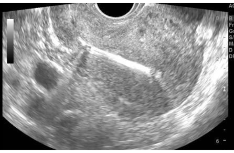 Bề dày niêm mạc tử cung 6mm Chưa quan sát thấy hình ảnh túi thai