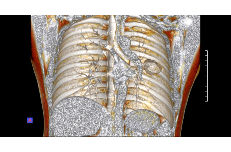 Hình ảnh chụp trên CLVT của bệnh nhân