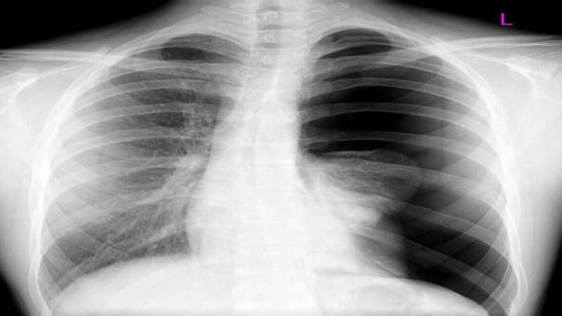 Cẩm nang y tế: tràn khí màng phổi nguy hiểm không?