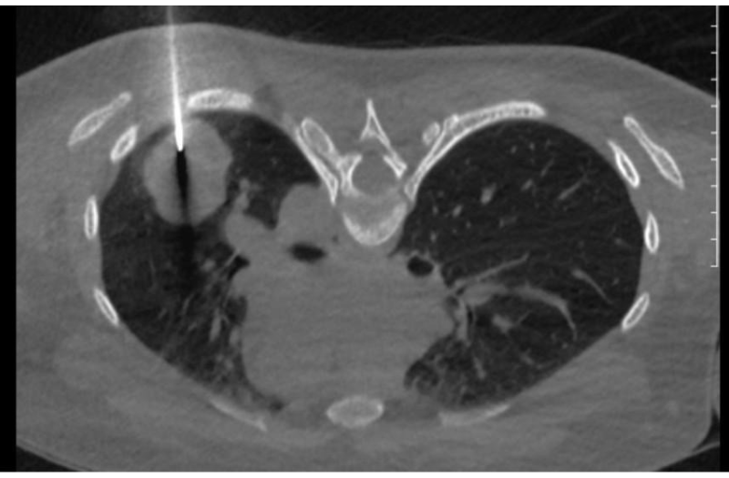 Hình ảnh sinh thiết u phổi trái của Bệnh nhân