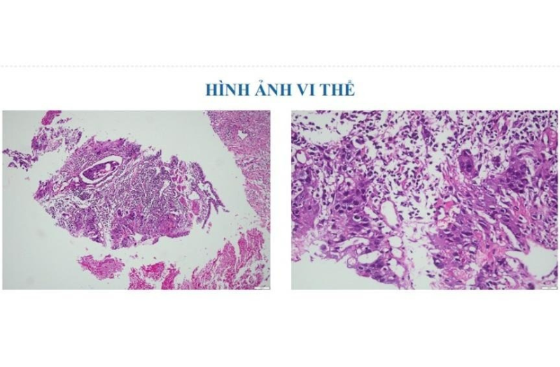 Hình ảnh xét nghiệm mô bệnh học